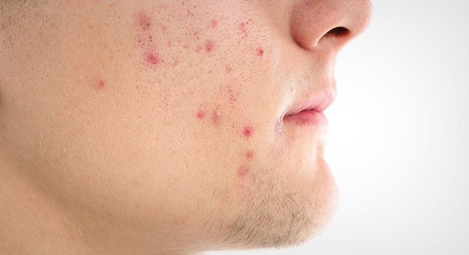 Acne Before